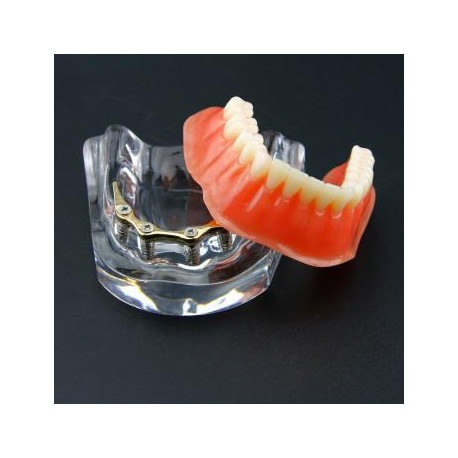 Dental Sobredentadura Typodont Modelo Inferior Precision Implant Dorado 6009