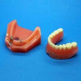 Modelo dental M-6007 Reparación del implante dental